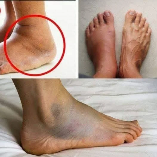 Infarkt u žen: příznaky a věk výskytu infarktu.
