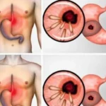 Bakterie způsobující pálení žáhy a nadýmání - jak je odstranit
