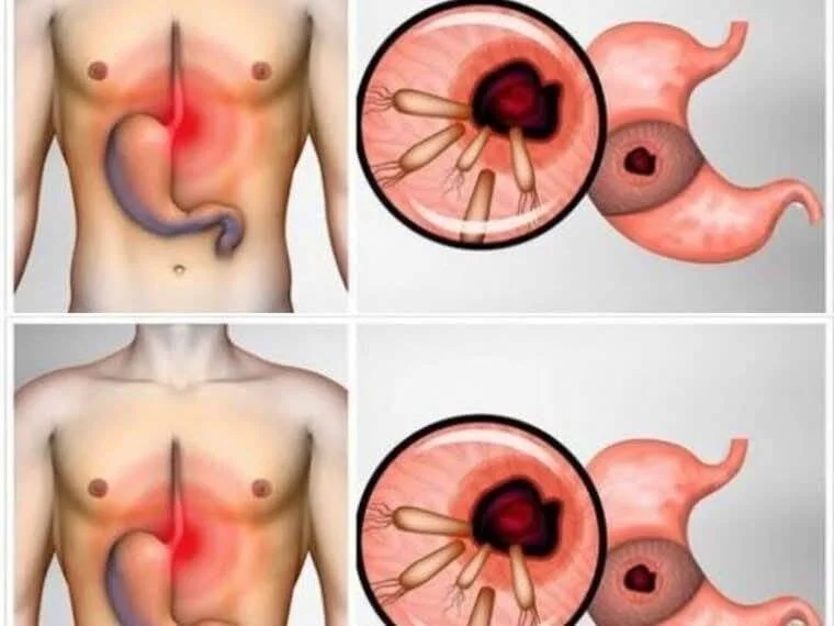 Bakterie způsobující pálení žáhy a nadýmání - jak je odstranit