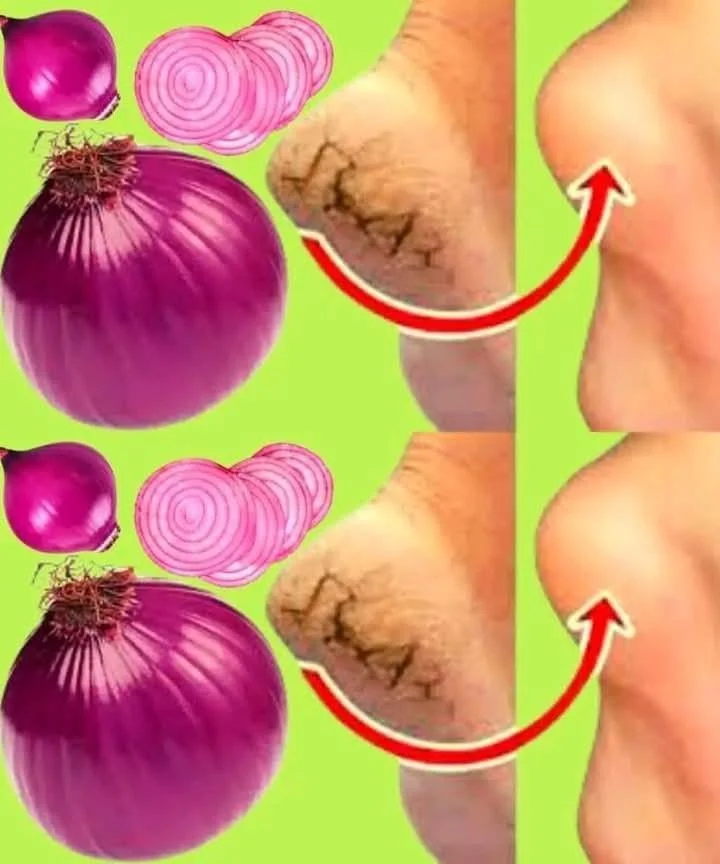 Léčení popraskaných pat pomocí cibule pro zdravé nohy