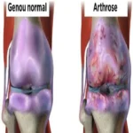 Přírodní léčba bolesti kloubů a osteoartrózy kolene