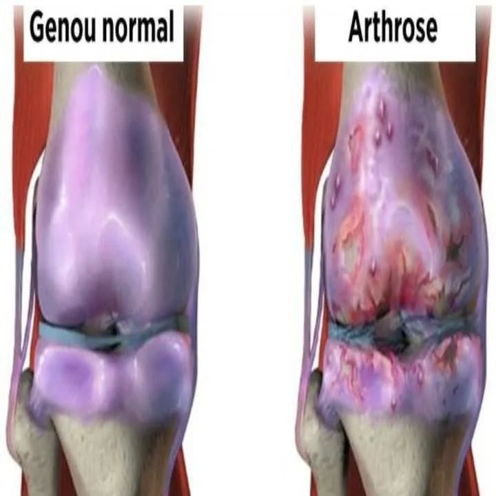 Přírodní léčba bolesti kloubů a osteoartrózy kolene