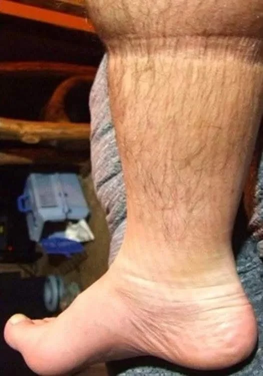 Varovné příznaky srdečního infarktu před jeho vznikem